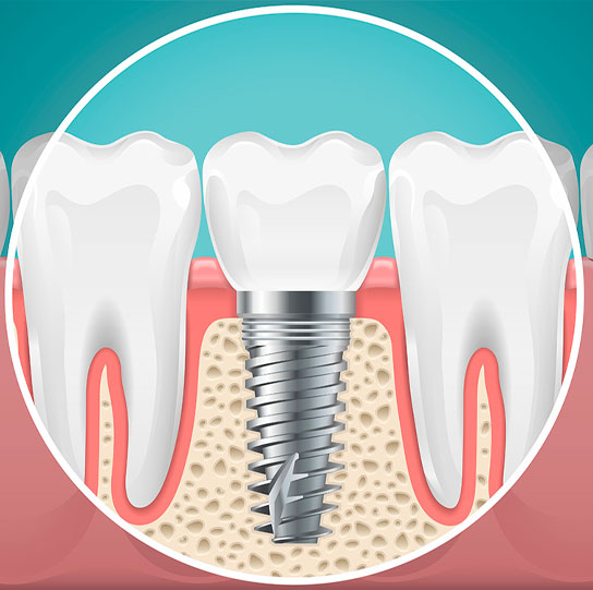 Implant dentaire Monteux