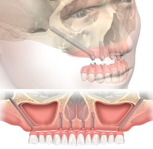 Implant dentaire zygomatique Monteux